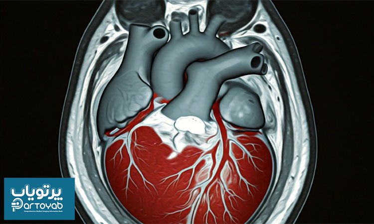 ام آر آی قلبی (کاردیاک)  چگونه انجام می شود؟