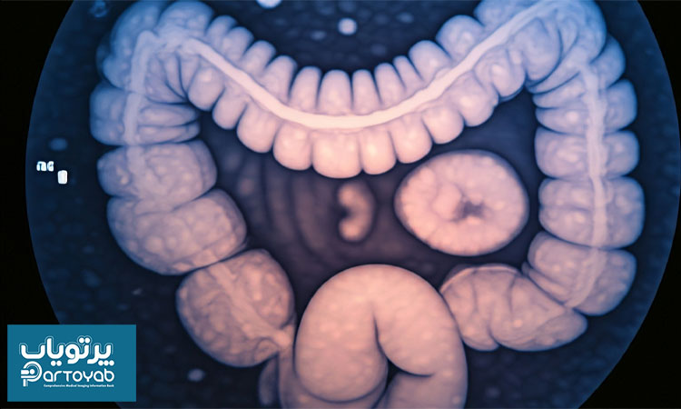 فرق عکس رنگی روده با کولونوسکوپی
